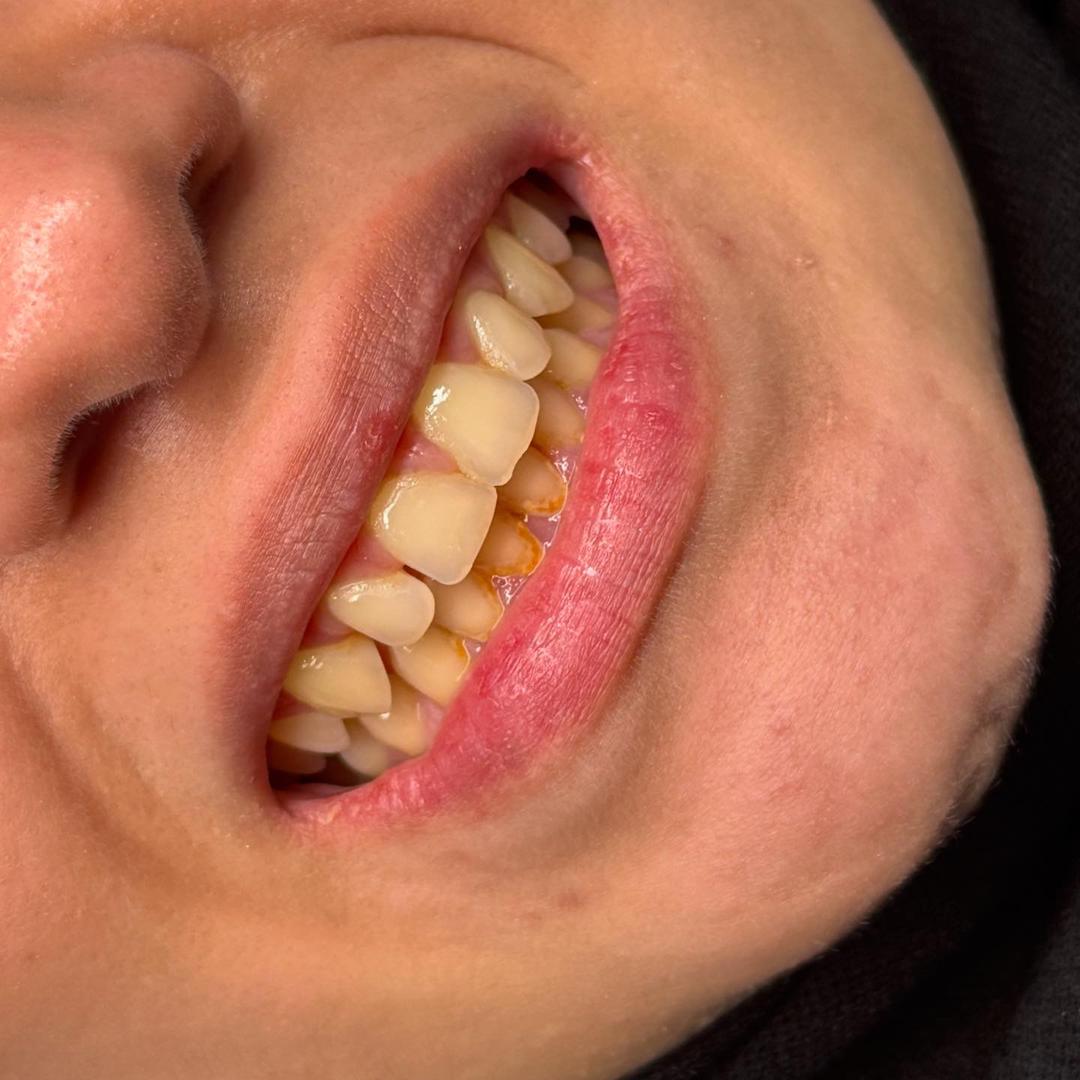 Dental Before
