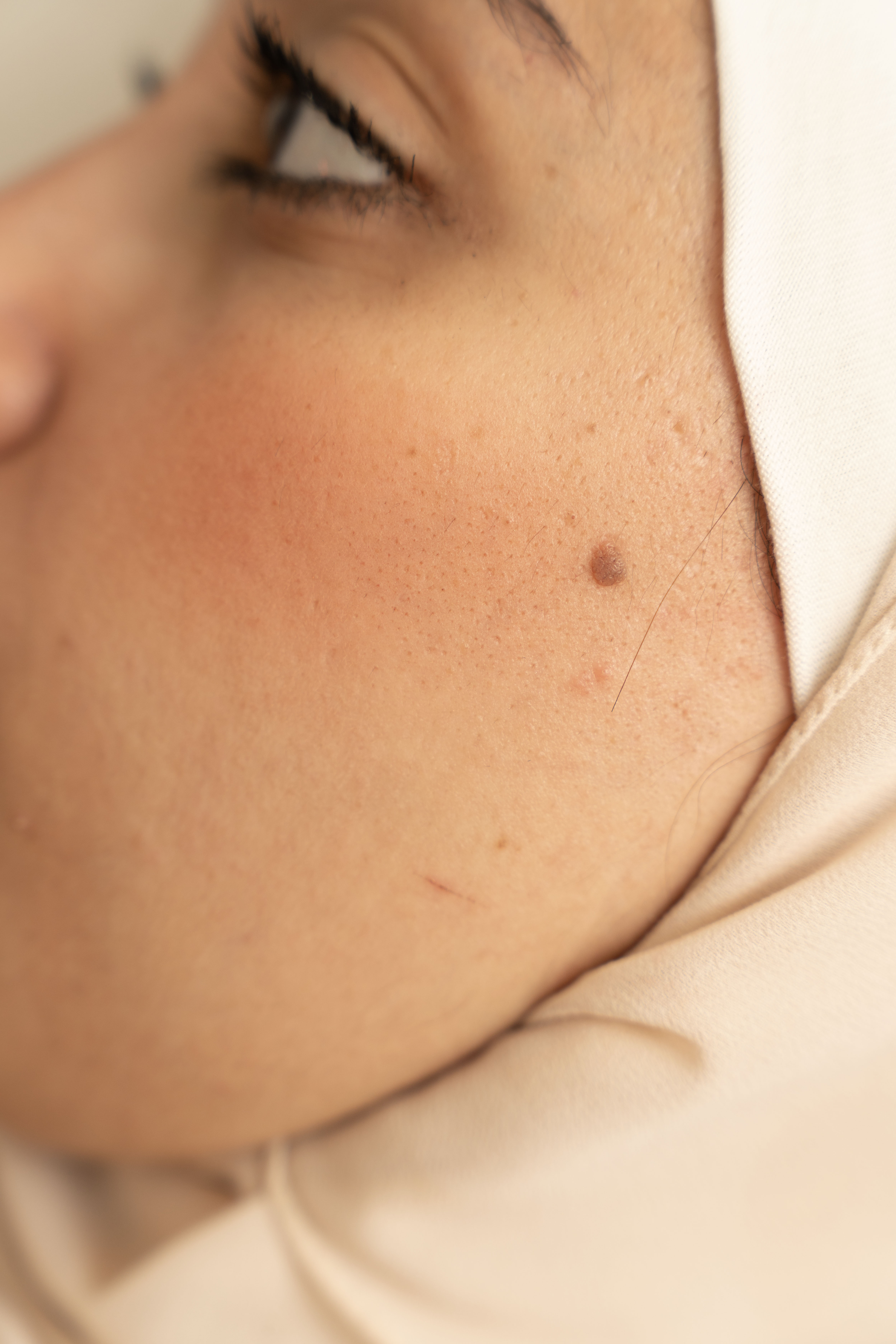 Mole Removal Before