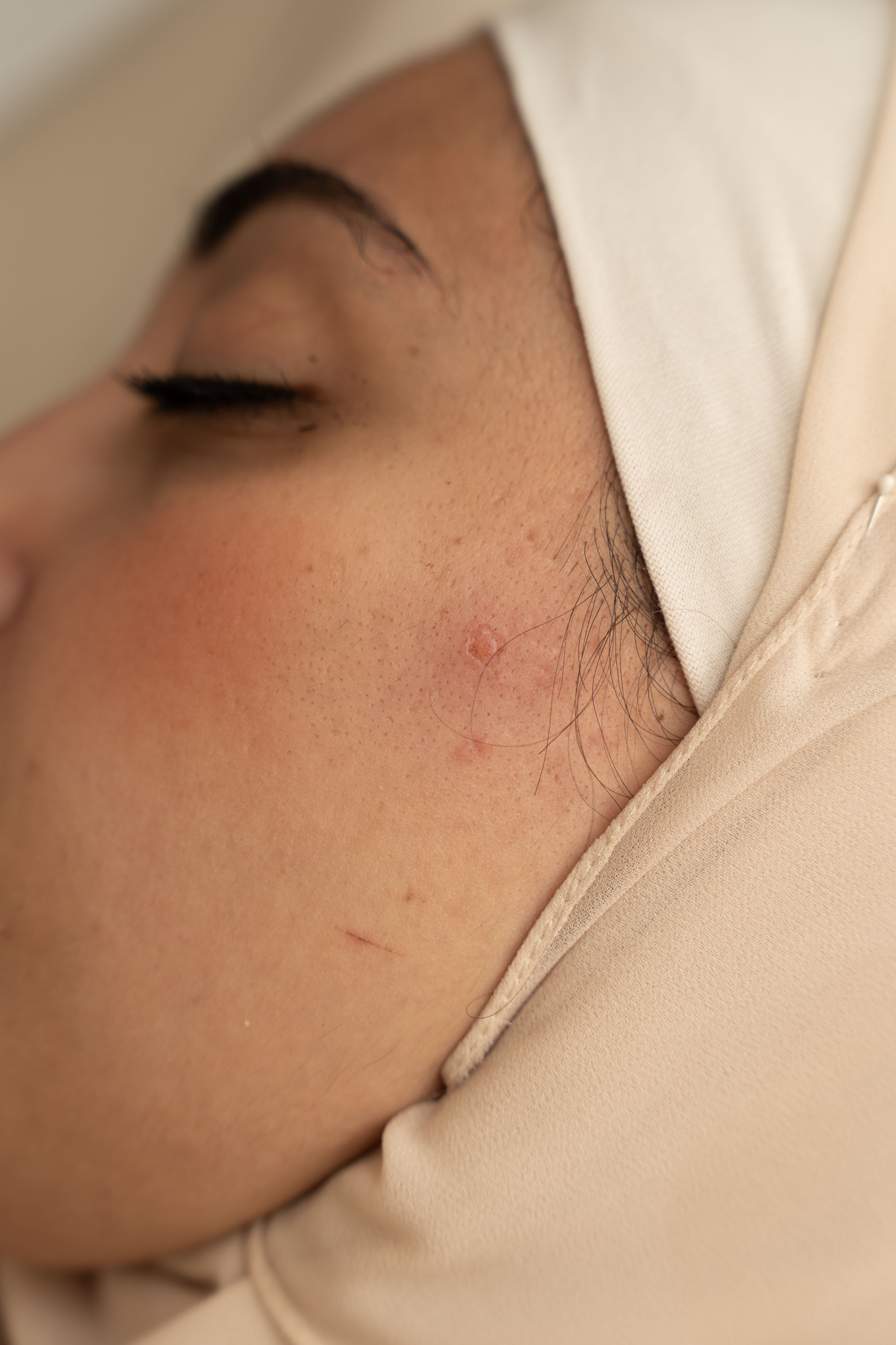 Mole Removal After