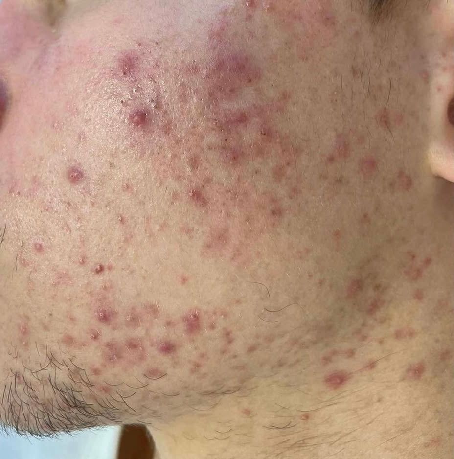 Skin Treatment After